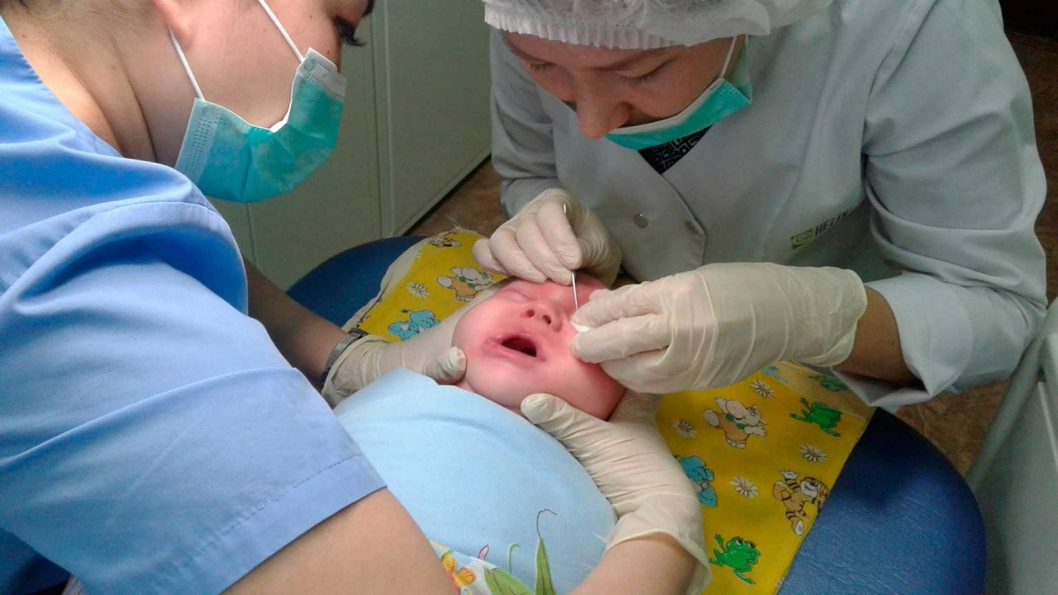 Показания для проведения зондирования слезного канала у новорожденных и последствия