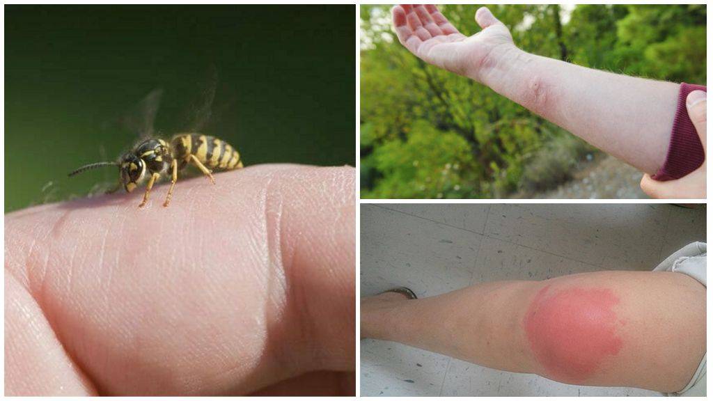 Что делать после укуса насекомого: первая помощь и алгоритм действий