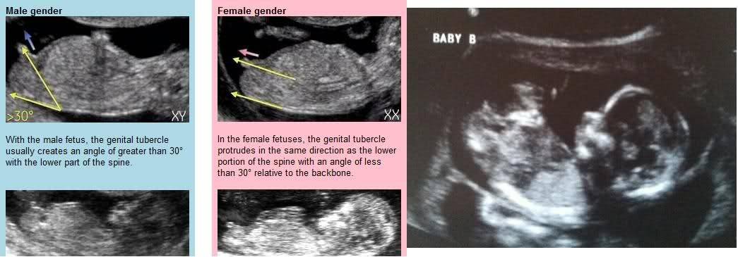 Узи в 12 недель беременности: можно ли узнать пол ребенка, как проходит и что показывает, как подготовится к обследованию, фото, как выглядит мальчик и девочка