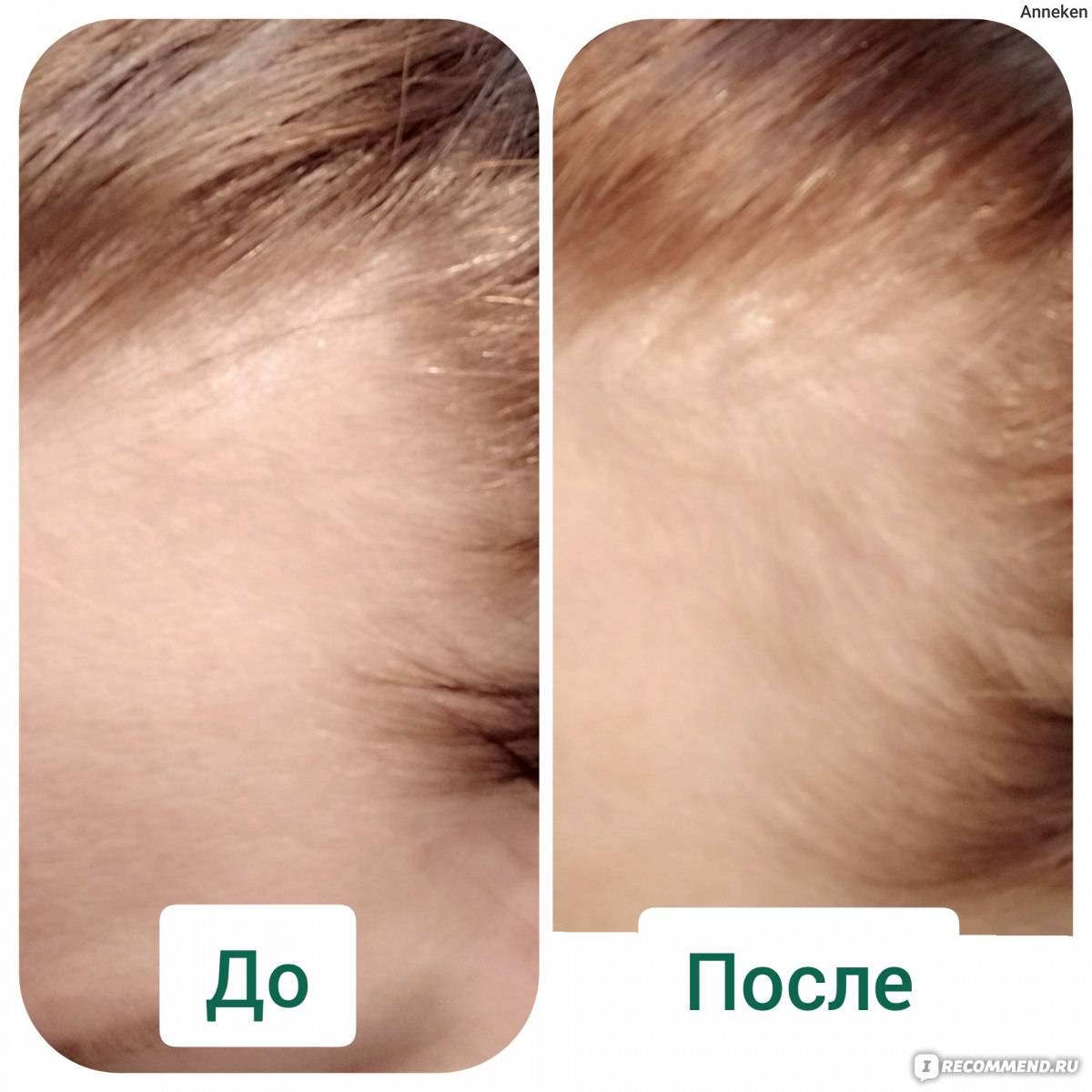 Уход за волосами после родов: выпадение волос и окрашивании при грудном вскармливании
