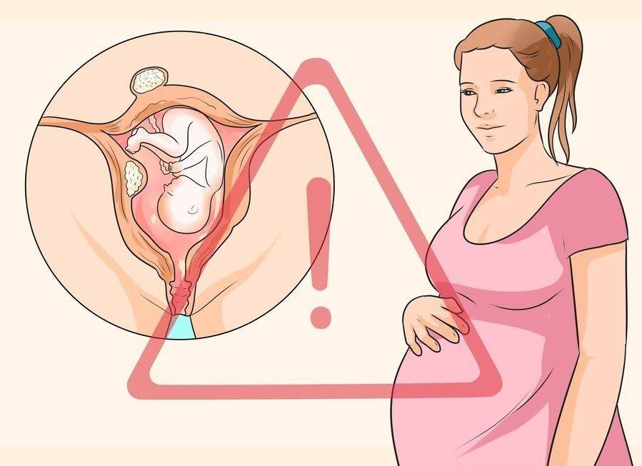 Роды при миоме матки | после родов