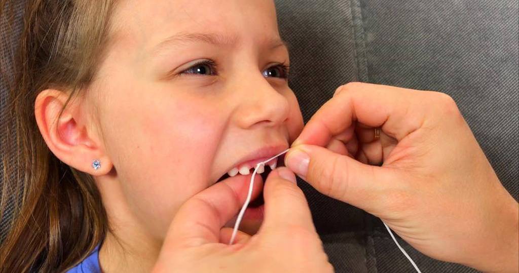Выпадение молочных зубов - почему, когда  и как ускорить | особенности ухода выпадают молочные зубы | как облегчить боль при прорезывании молочных зубов | выпал зуб у ребенка что делать