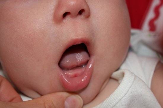 Белые пятнышки или точки на деснах, во рту и на языке у грудничка