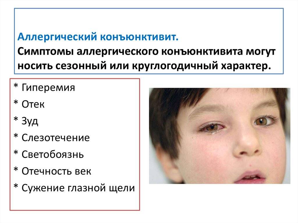 Конъюнктивит как осложнение орви - энциклопедия ochkov.net