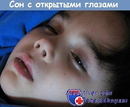 Почему ребенок спит с приоткрытыми глазами, какие могут быть причины?