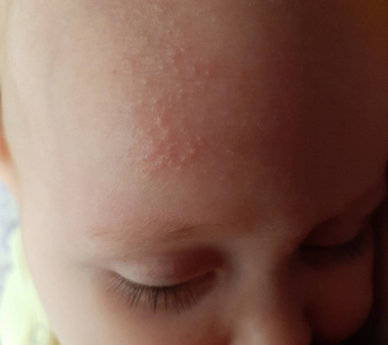 дерматит на теле ребенка фото