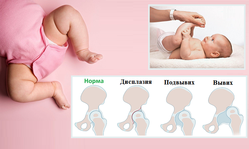 Узи тазобедренных суставов новорожденным