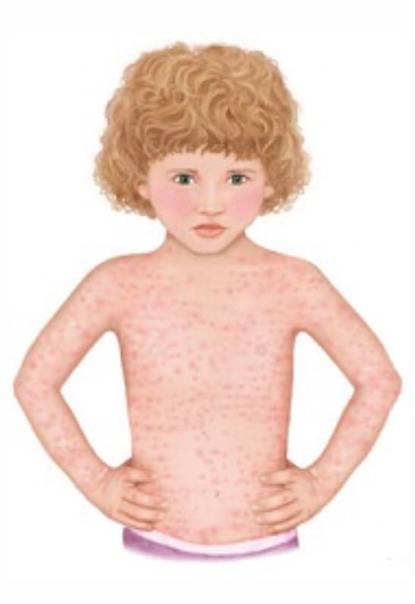 ???? розеола у детей: симптомы с фото сыпи, лечение трехдневной лихорадки, профилактика