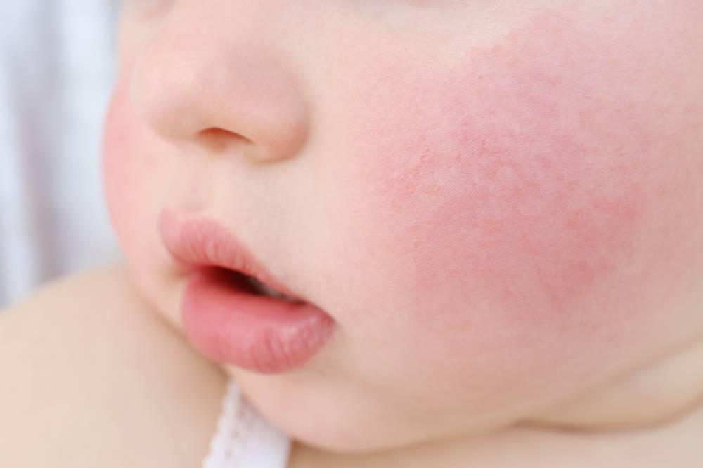 Аллергия на лице у ребёнка - что делать и как лечить?