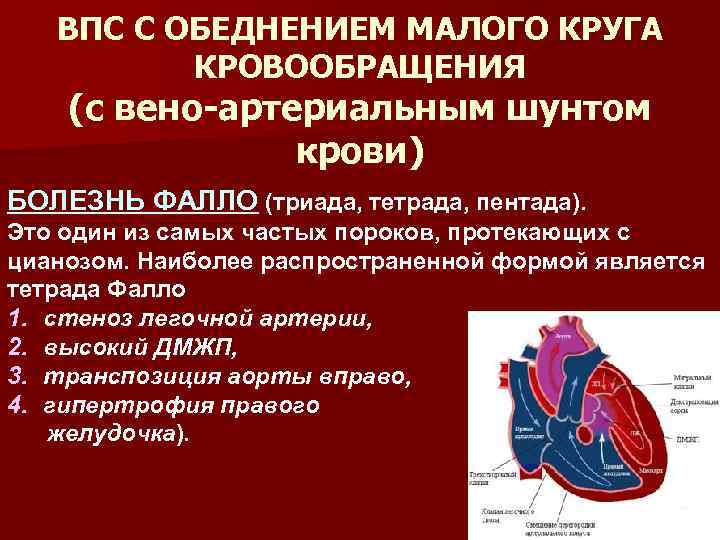 Врождённый порок сердца (впс) у детей