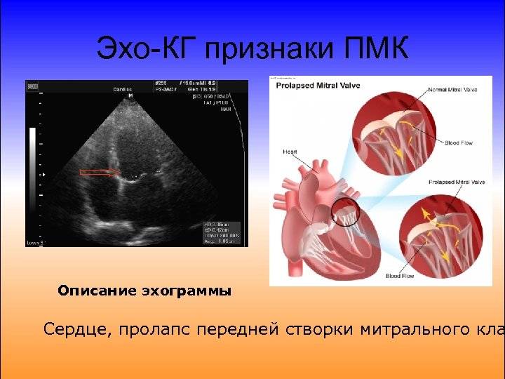 Пролапс митрального клапана презентация