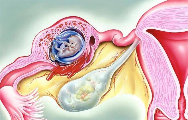 Может ли повториться внематочная беременность | новости медицины