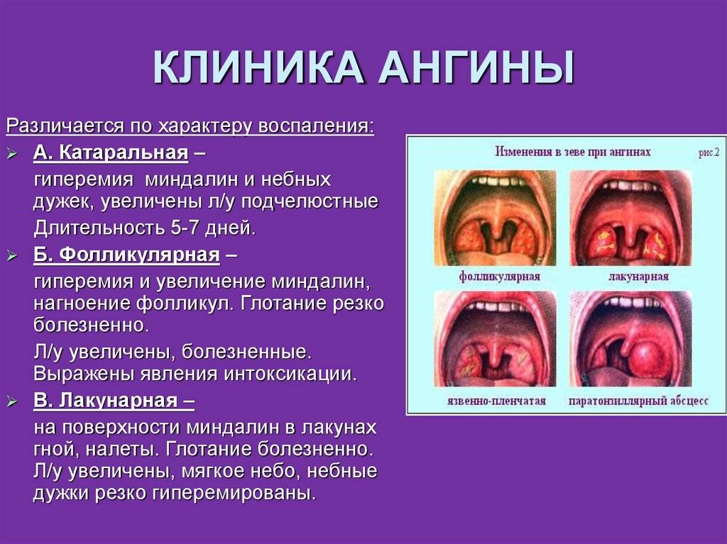 Профилактика стрептококовой (группы а) инфекции - огбуз поликлиника №4 смоленск
