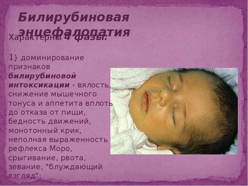 Желтушка у новорожденных: виды, причины, последствия, лечение, профилактика, видео
