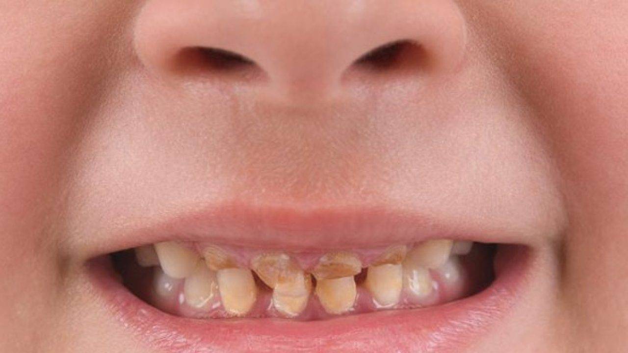 Неровные, волнистые или желтые зубы у детей: что делать