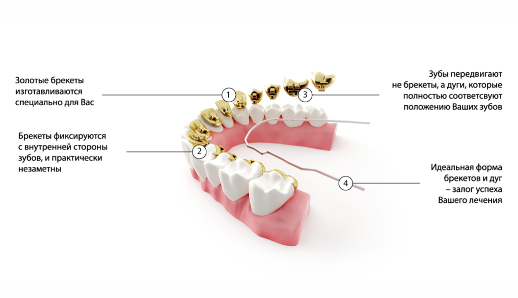 Какие зубы удаляют. Брекеты схема. Строение брекетов. Схема установки брекет системы.