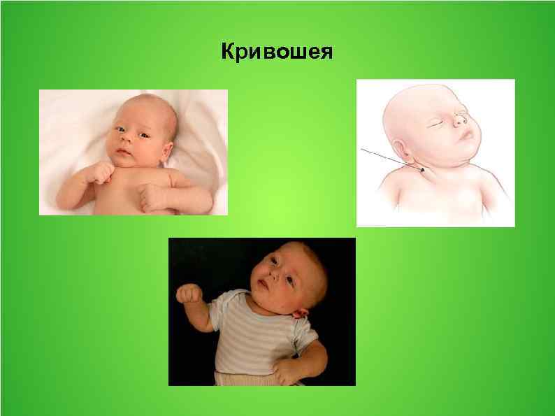 Кривошея у новорожденных, кривошея у ребенка 3 месяца симптомы кривошея у новорожденных признаки фото
