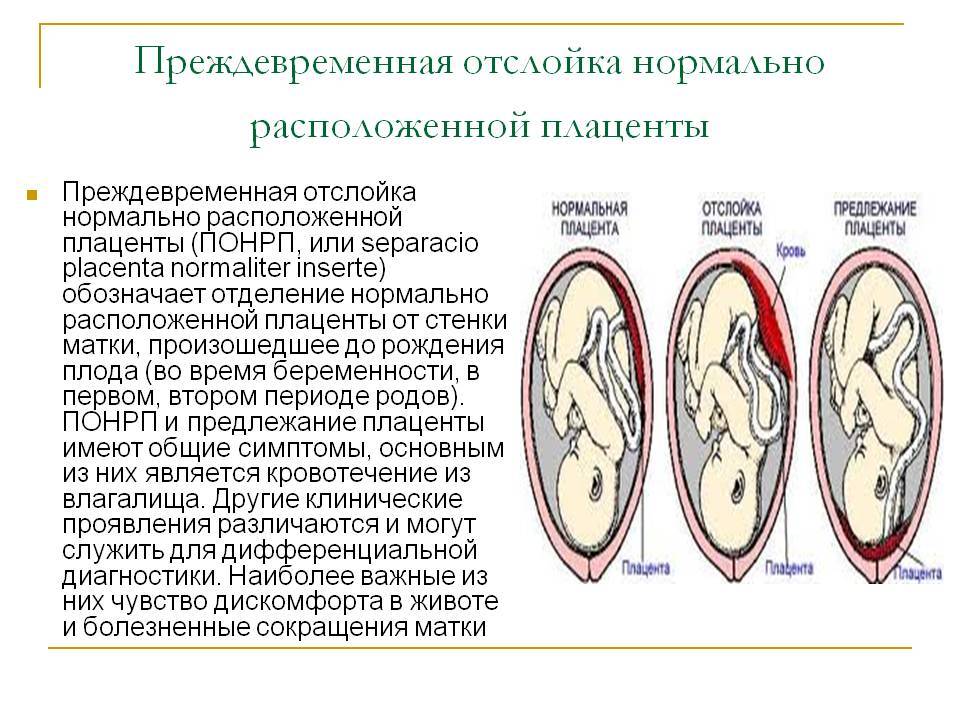 Отслойка плаценты на ранних и поздних сроках, отслойка нормально распложенной плаценты: симптомы, диагностика, лечение / mama66.ru