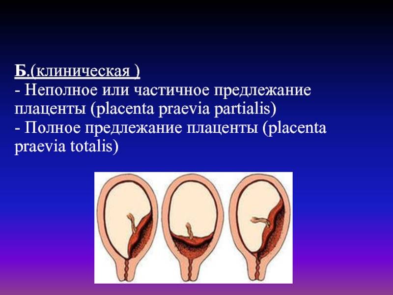 Предлежание плаценты при беременности: причины, симптомы, диагностика и лечение