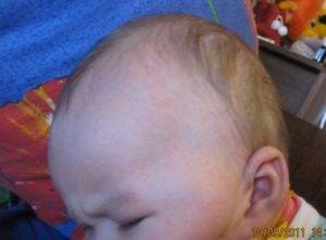 Шишка на голове, попе или после уколов у грудного ребенка