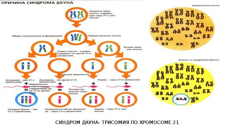 Синдром дауна механизм. Синдром Дауна 21 хромосома. Синдром Дауна трисомия 21 хромосомы. Синдром Дауна схема хромосом. Синдром Дауна геномная мутация.