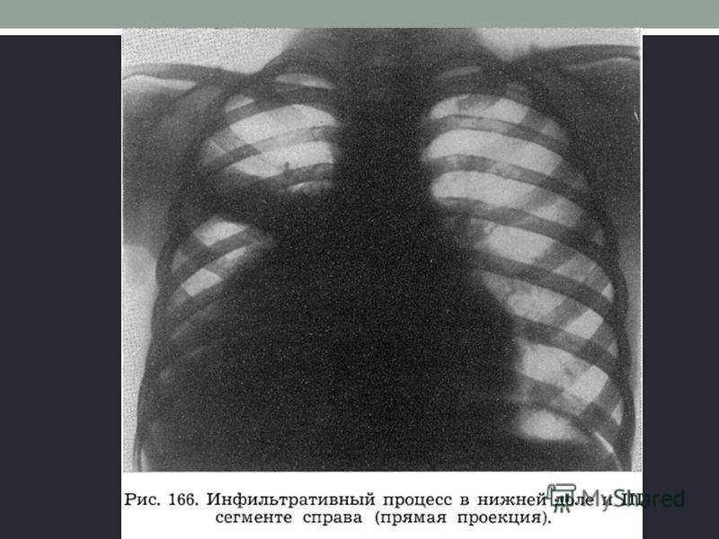 Флюорография при грудном вскармливании: особенности диагностики